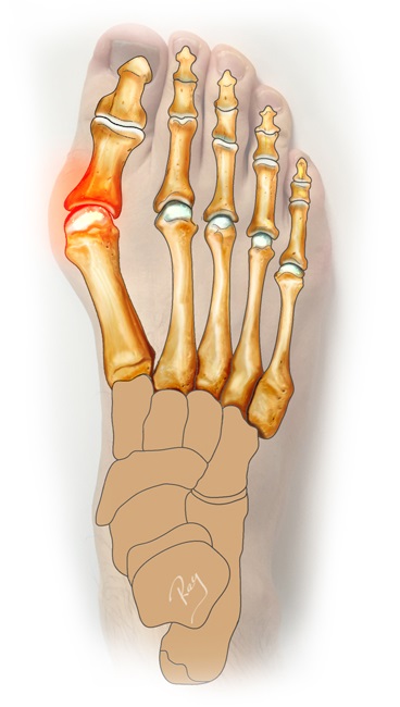 Diagnostika hallux valgus podoskopom